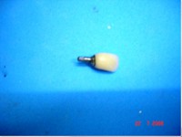 /album/galeria-de-fotos-carga-imediata-apos-exodontia-atraumatica-/carga-imediata-com-exodontia-atraumatica16-jpg/